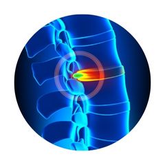 Niskakaari lievittää nikamien välistä painetta ja lievittää kipua